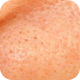 Blackheads